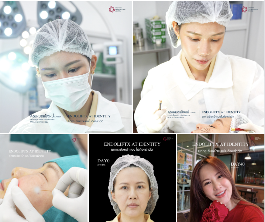 อยากยกกระชับหน้า แต่ไม่อยากผ่าตัด? สวยสั่งได้ไม่ต้องดมยาสลบด้วย EndoliftX ที่ Identity