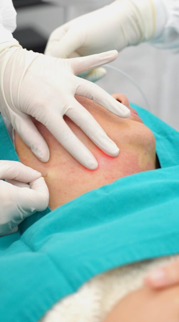 สอดสาย Micro Fiber ใต้ผิวบริเวณกรอบหน้าระหว่างทำ EndoliftX